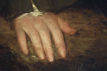 Click the image for a view of: Detail of hand, before treatment